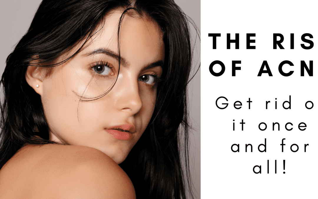 The rise of Acne.Get rid of it once and for all!